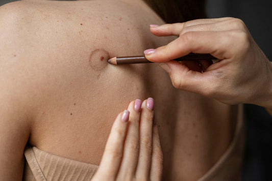 Skin Tags Prevention: Tips for Healthy Skin