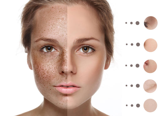 A half face show dull, acne and pigmentation; another half face show bright, clear and smooth after pico laser treatment
