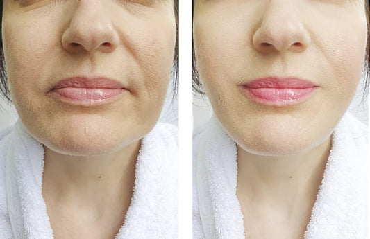 A left side are the original picture before do hifu treatment. Right side picture are the result after doing hifu treatment.