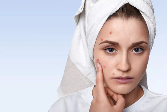 A girl face have red acne