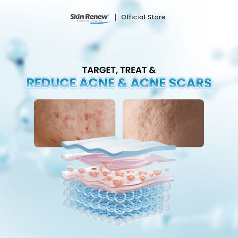 Skin Renew Dermis Gel