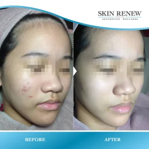 Acne-_-Scar-Before-_-After-05